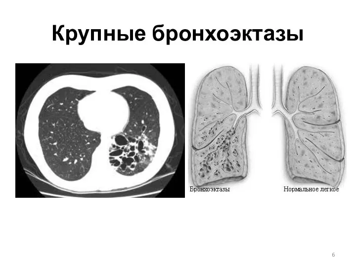 Крупные бронхоэктазы