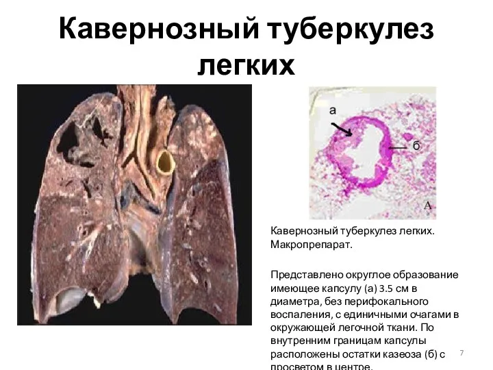 Кавернозный туберкулез легких Кавернозный туберкулез легких. Макропрепарат. Представлено округлое образование