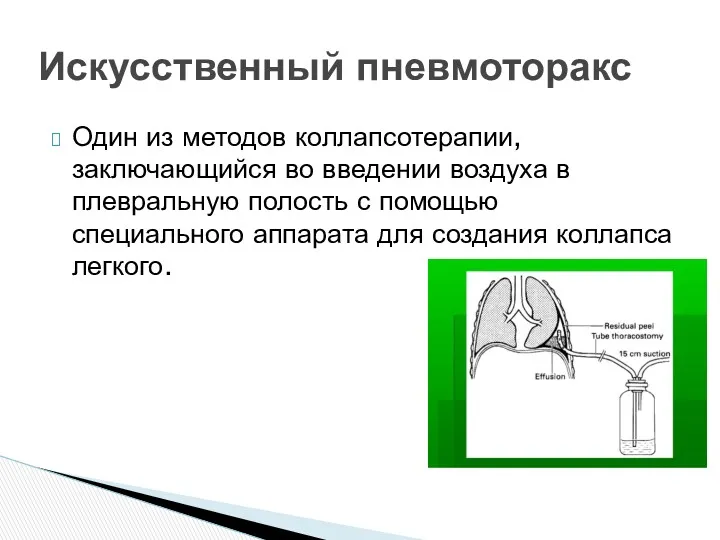 Один из методов коллапсотерапии, заключающийся во введении воздуха в плевральную