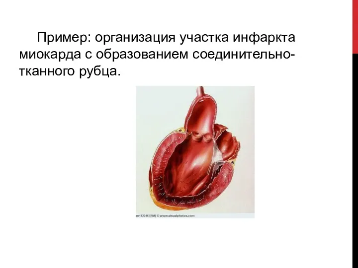 Пример: организация участка инфаркта миокарда с образованием соединительно-тканного рубца.
