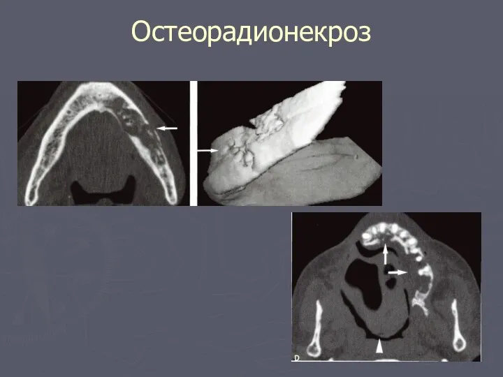 Остеорадионекроз