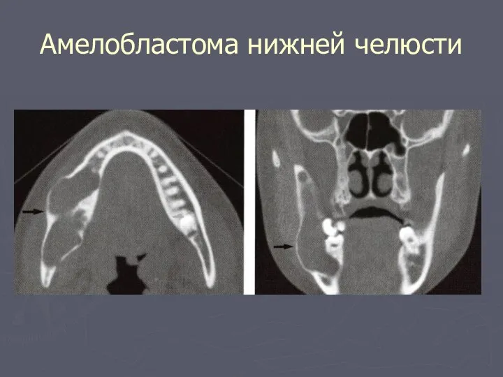 Амелобластома нижней челюсти