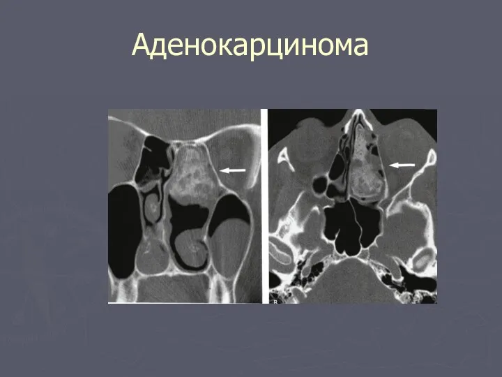 Аденокарцинома