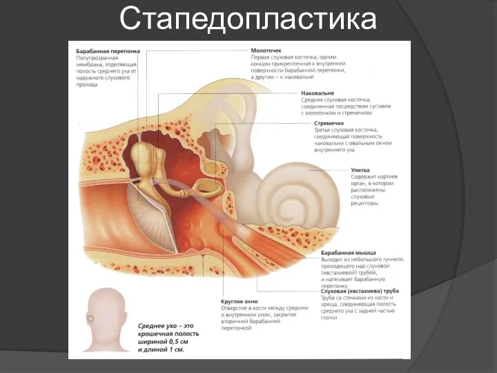 Стапедопластика