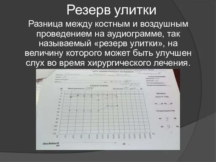 Резерв улитки Разница между костным и воздушным проведением на аудиограмме,