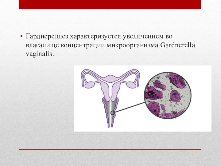 Гарднереллез характеризуется увеличением во влагалище концентрации микроорганизма Gardnerella vaginalis.