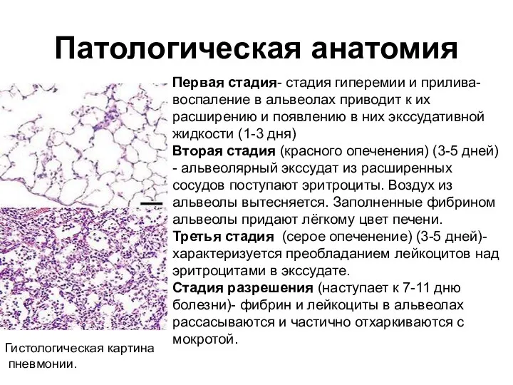 Патологическая анатомия Гистологическая картина пневмонии. Первая стадия- стадия гиперемии и