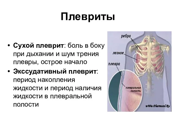 Плевриты Сухой плеврит: боль в боку при дыхании и шум