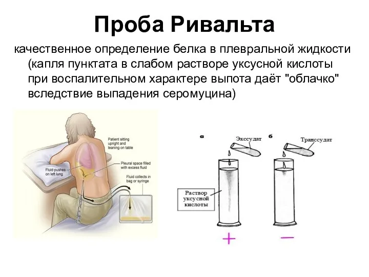 Проба Ривальта качественное определение белка в плевральной жидкости (капля пунктата