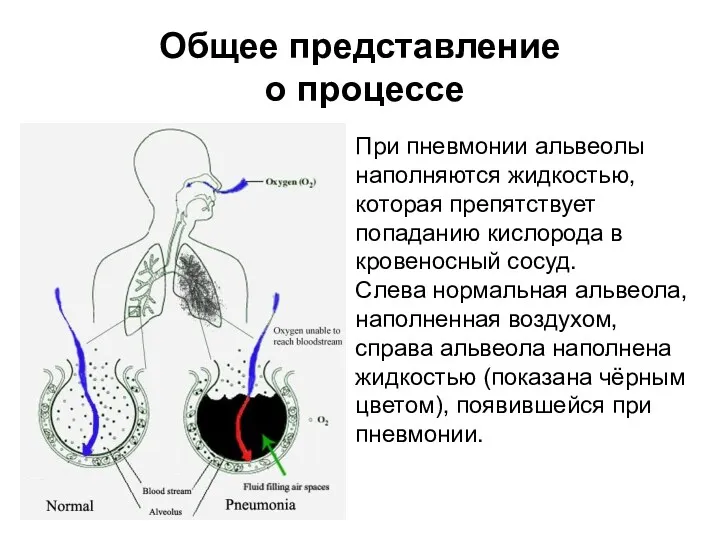 Общее представление о процессе При пневмонии альвеолы наполняются жидкостью, которая