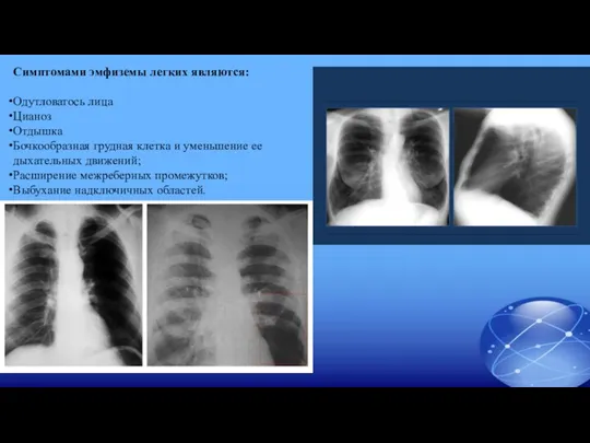 Симптомами эмфиземы легких являются: Одутловатось лица Цианоз Отдышка Бочкообразная грудная