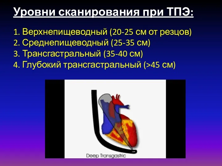 Уровни сканирования при ТПЭ: 1. Верхнепищеводный (20-25 см от резцов)