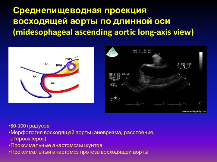 Среднепищеводная проекция восходящей аорты по длинной оси (midesophageal ascending aortic