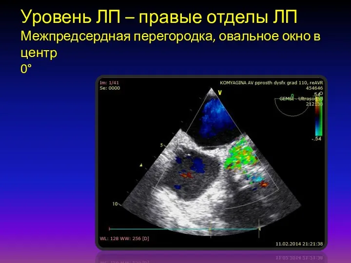 Уровень ЛП – правые отделы ЛП Межпредсердная перегородка, овальное окно в центр 0°