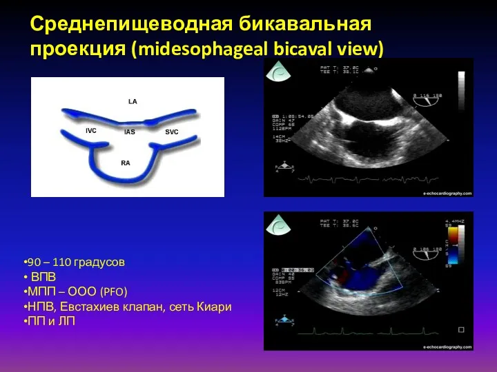 Среднепищеводная бикавальная проекция (midesophageal bicaval view) 90 – 110 градусов