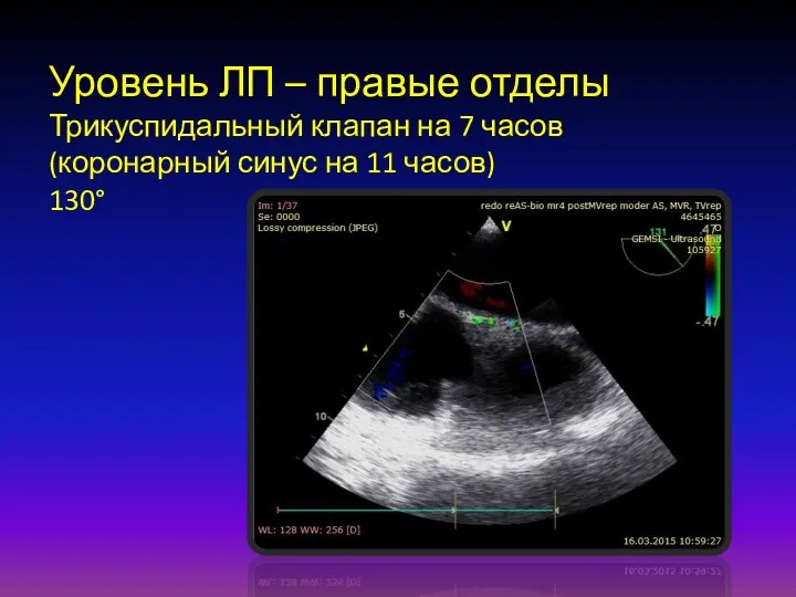 Уровень ЛП – правые отделы Трикуспидальный клапан на 7 часов (коронарный синус на 11 часов) 130°