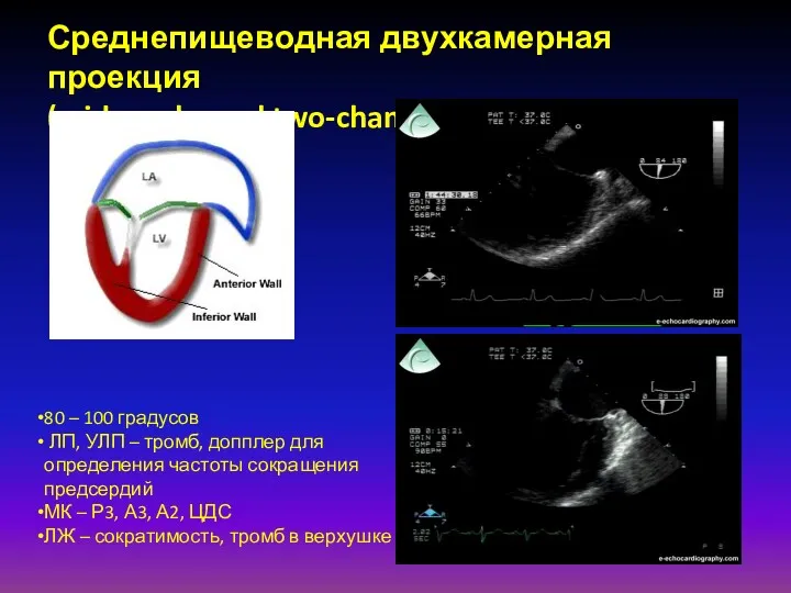 Среднепищеводная двухкамерная проекция (midesophageal two-chamber view) 80 – 100 градусов