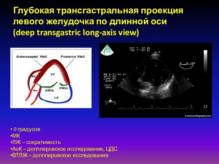 Глубокая трансгастральная проекция левого желудочка по длинной оси (deep transgastric