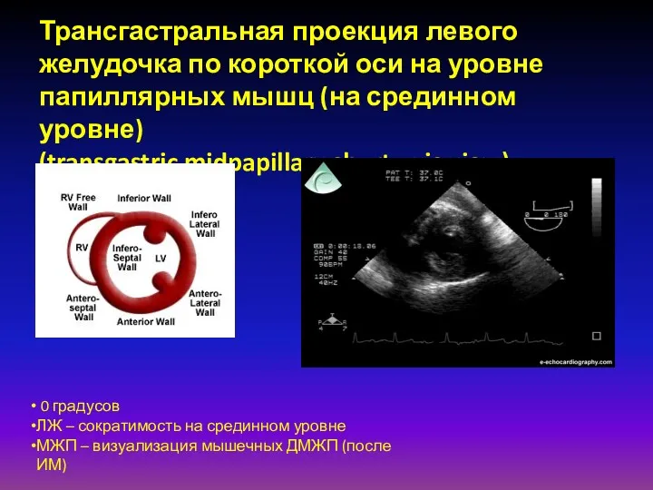 Трансгастральная проекция левого желудочка по короткой оси на уровне папиллярных