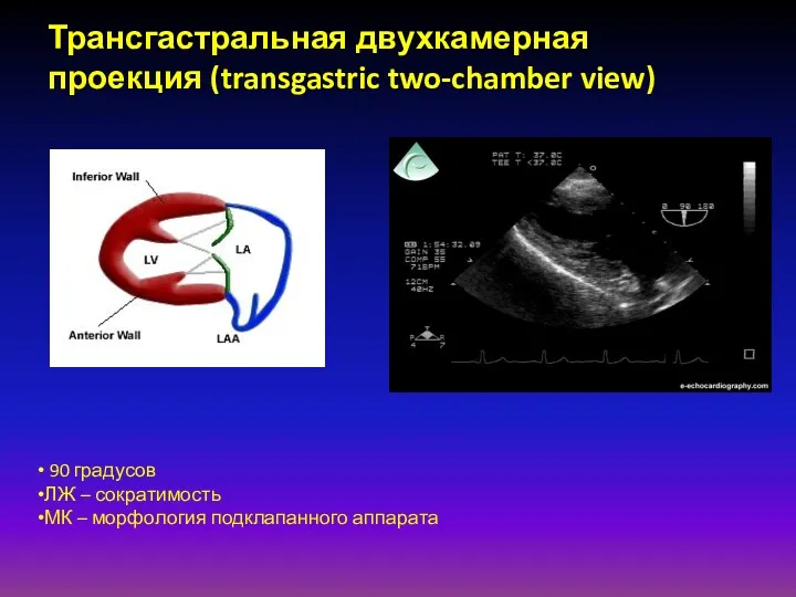 Трансгастральная двухкамерная проекция (transgastric two-chamber view) 90 градусов ЛЖ – сократимость МК – морфология подклапанного аппарата