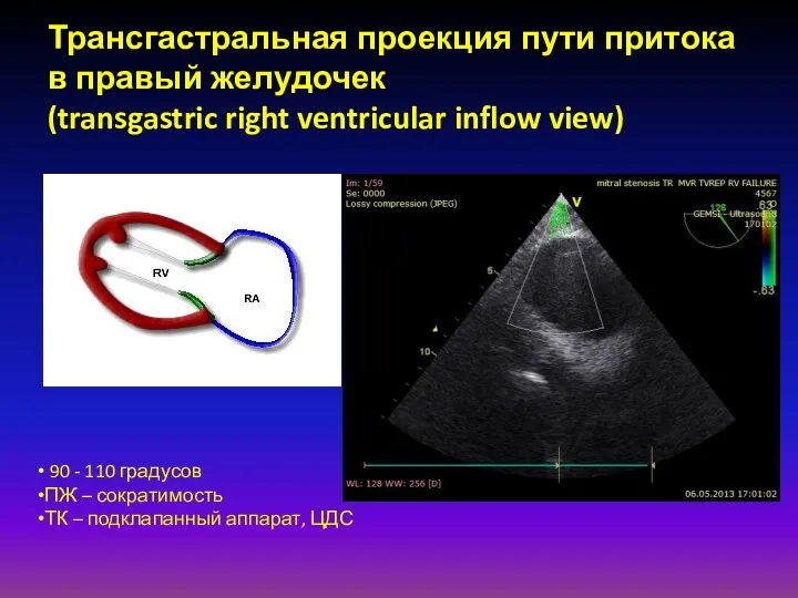 Трансгастральная проекция пути притока в правый желудочек (transgastric right ventricular
