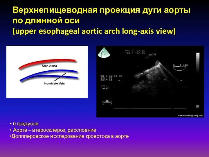 Верхнепищеводная проекция дуги аорты по длинной оси (upper esophageal aortic