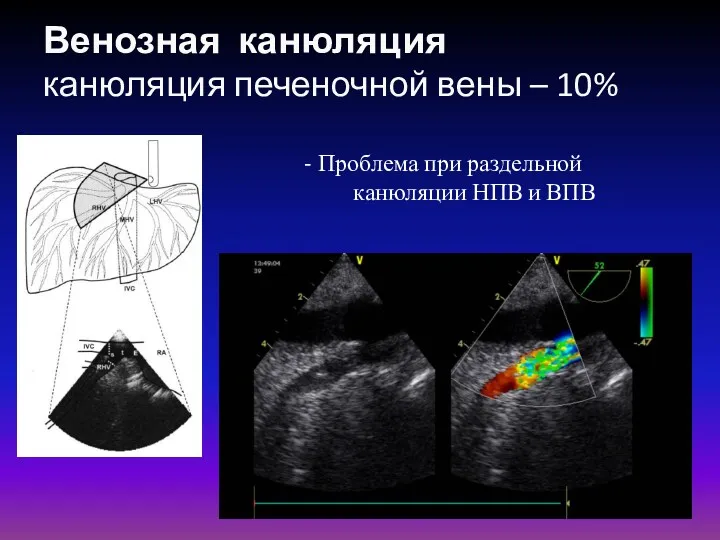 Венозная канюляция канюляция печеночной вены – 10% - Проблема при раздельной канюляции НПВ и ВПВ