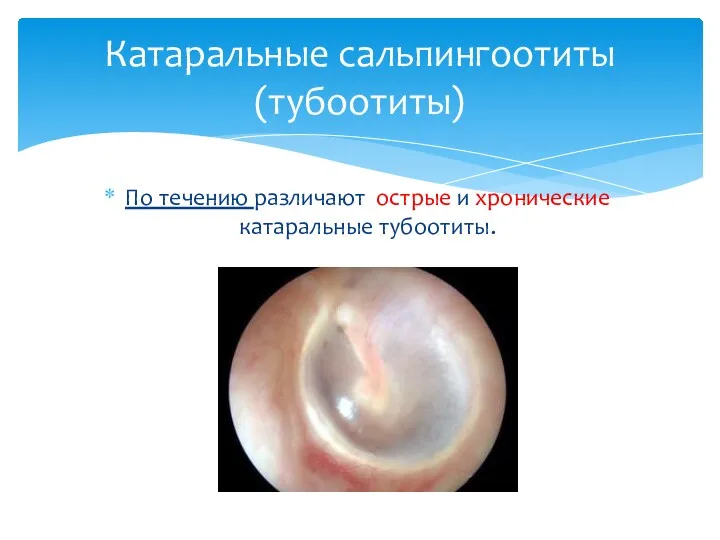 По течению различают острые и хронические катаральные тубоотиты. Катаральные сальпингоотиты(тубоотиты)