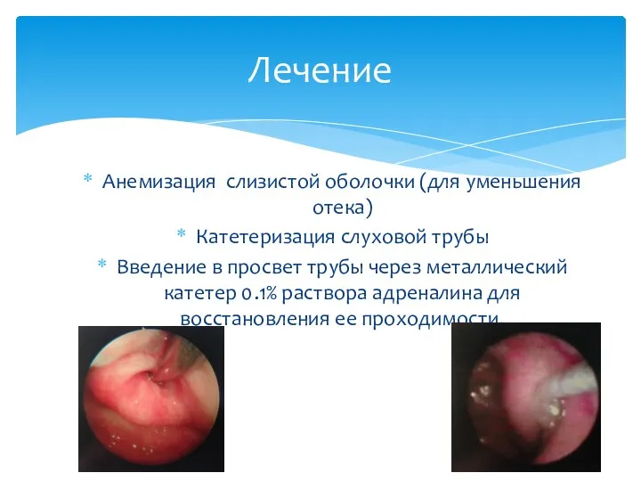 Анемизация слизистой оболочки (для уменьшения отека) Катетеризация слуховой трубы Введение