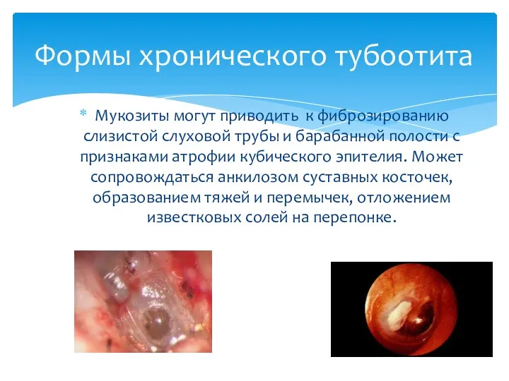 Мукозиты могут приводить к фиброзированию слизистой слуховой трубы и барабанной