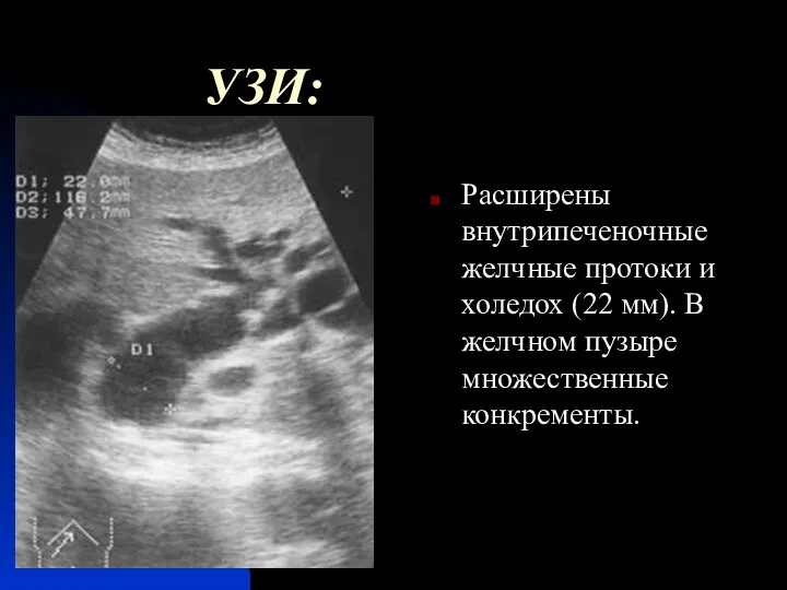 УЗИ: Расширены внутрипеченочные желчные протоки и холедох (22 мм). В желчном пузыре множественные конкременты.