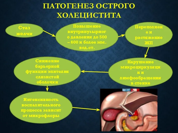 ПАТОГЕНЕЗ ОСТРОГО ХОЛЕЦИСТИТА Стаз желчи Повышение внутрипузырного давления до 500