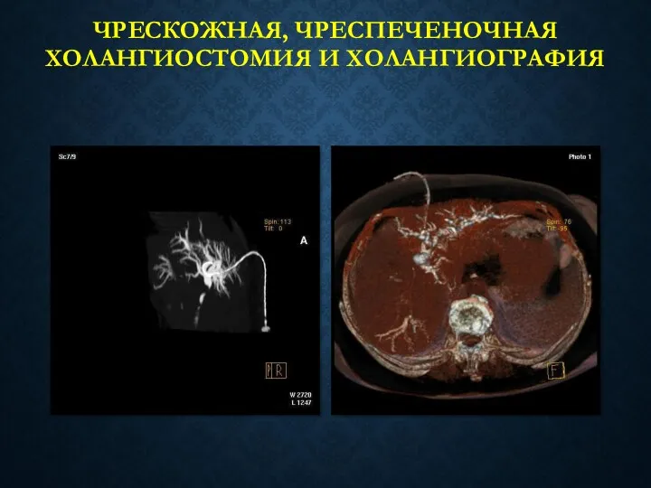 ЧРЕСКОЖНАЯ, ЧРЕСПЕЧЕНОЧНАЯ ХОЛАНГИОСТОМИЯ И ХОЛАНГИОГРАФИЯ