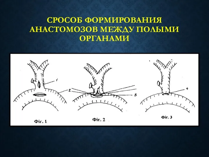 СРОСОБ ФОРМИРОВАНИЯ АНАСТОМОЗОВ МЕЖДУ ПОЛЫМИ ОРГАНАМИ