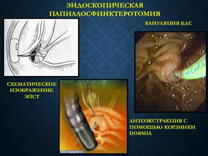 ЭНДОСКОПИЧЕСКАЯ ПАПИЛЛОСФИНКТЕРОТОМИЯ СХЕМАТИЧЕСКОЕ ИЗОБРАЖЕНИЕ ЭПСТ КАНУЛЯЦИЯ БДС ЛИТОЭКСТРАКЦИЯ С ПОМОЩЬЮ КОРЗИНКИ DORMIA