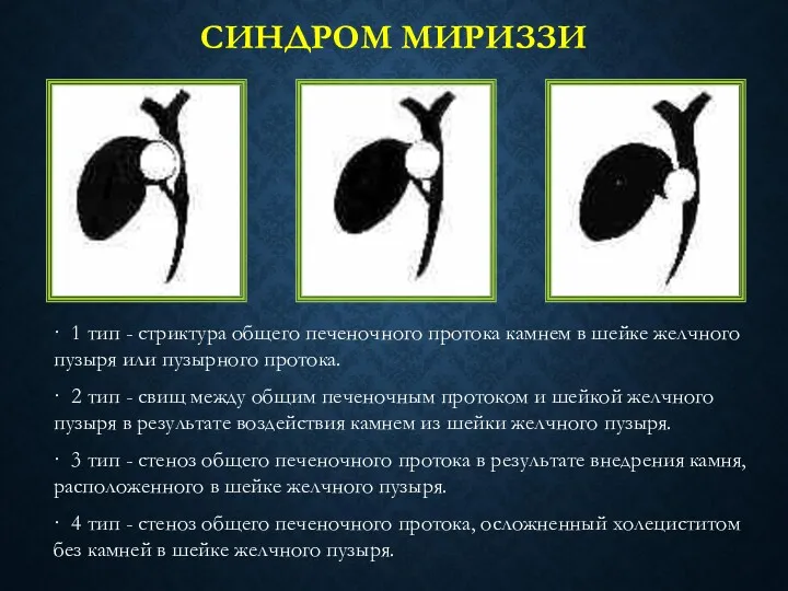 СИНДРОМ МИРИЗЗИ · 1 тип - стриктура общего печеночного протока