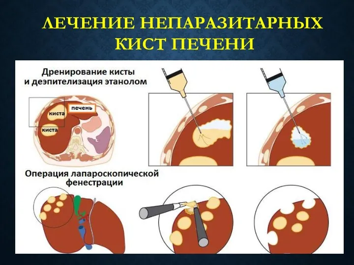 ЛЕЧЕНИЕ НЕПАРАЗИТАРНЫХ КИСТ ПЕЧЕНИ