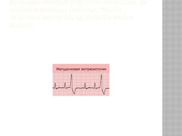 ҚАРЫНШАЛЫҚ ЭКСТРАСИСТОЛИЯ-ҚАРЫНШАЛАРДЫҢ ӨТКІЗГІШ ЖҮЙЕСІНІҢ ӘР ЖЕРІНЕН ШЫҚҚАН ИМПУЛЬСТЕРДІҢ ӘСЕРІНЕН ЖҮРЕКТІҢ МЕЗГІЛІНЕН БҰРЫН ҚОЗУЫ.