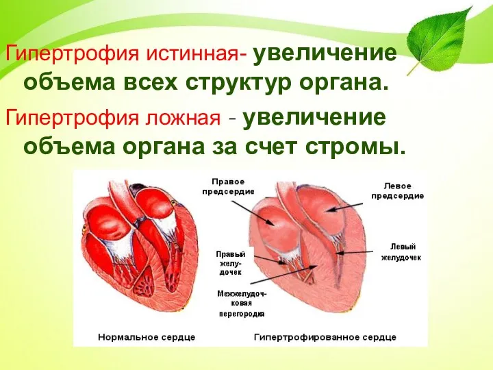 Гипертрофия истинная- увеличение объема всех структур органа. Гипертрофия ложная - увеличение объема органа за счет стромы.