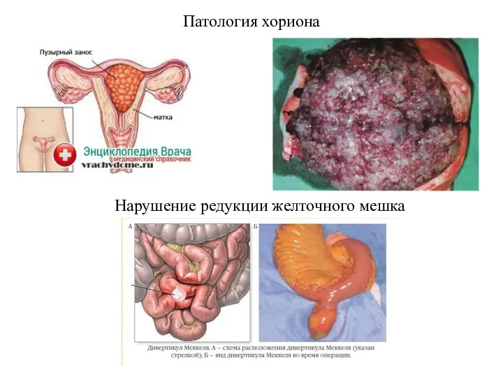 Патология хориона Нарушение редукции желточного мешка