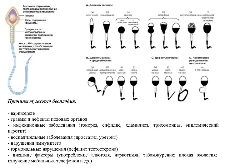 Причины мужского бесплодия: - варикоцеле - травмы и дефекты половых
