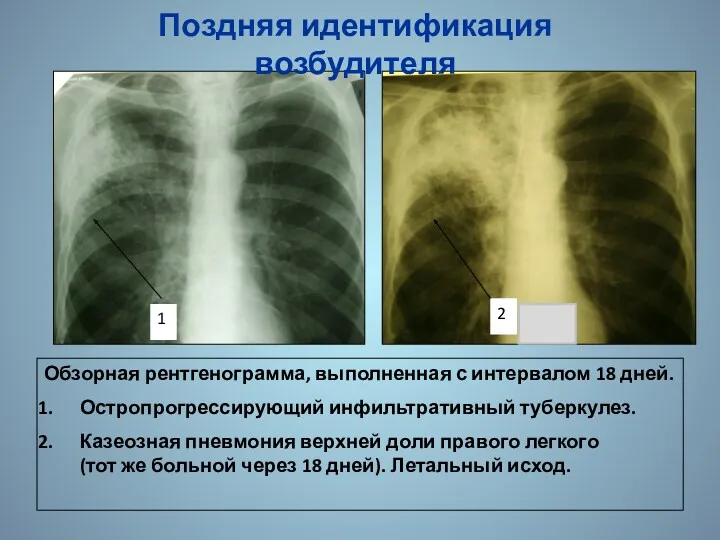 Обзорная рентгенограмма, выполненная с интервалом 18 дней. Остропрогрессирующий инфильтративный туберкулез.