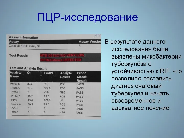 ПЦР-исследование В результате данного исследования были выявлены микобактерии туберкулёза с