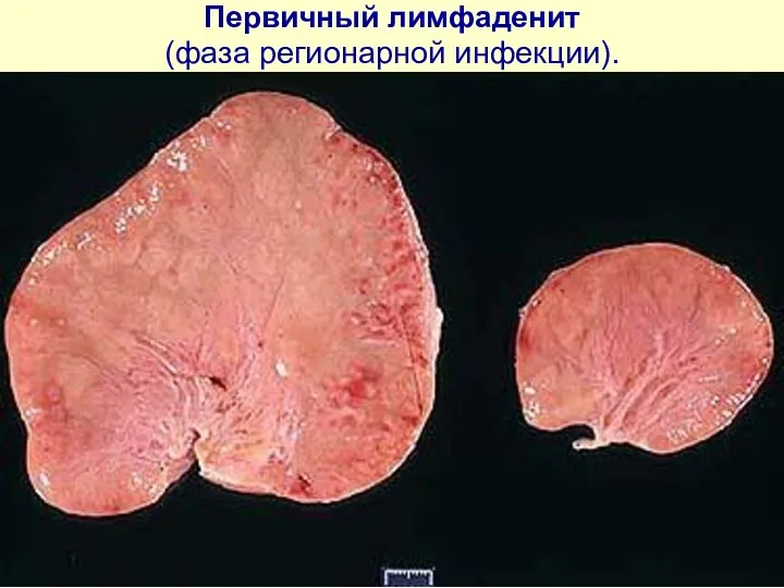 Пеpвичный лимфаденит (фаза регионарной инфекции).