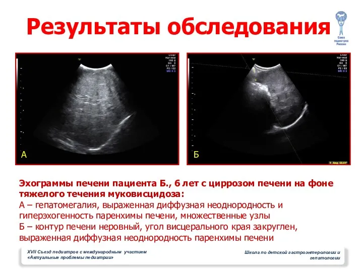 Результаты обследования А Б Эхограммы печени пациента Б., 6 лет