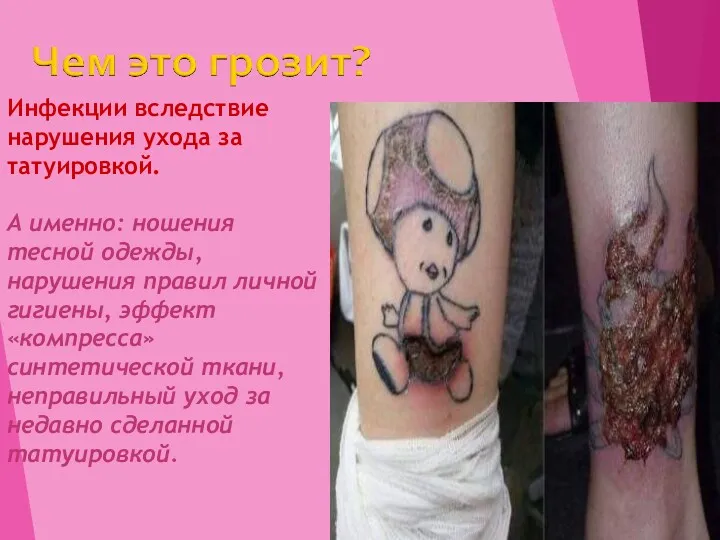Инфекции вследствие нарушения ухода за татуировкой. А именно: ношения тесной одежды, нарушения правил