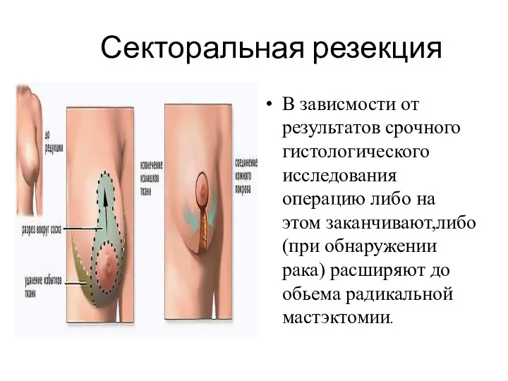 Секторальная резекция В зависмости от результатов срочного гистологического исследования операцию