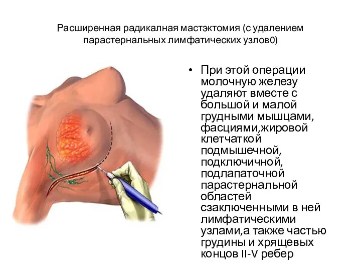 Расширенная радикалная мастэктомия (с удалением парастернальных лимфатических узлов0) При этой