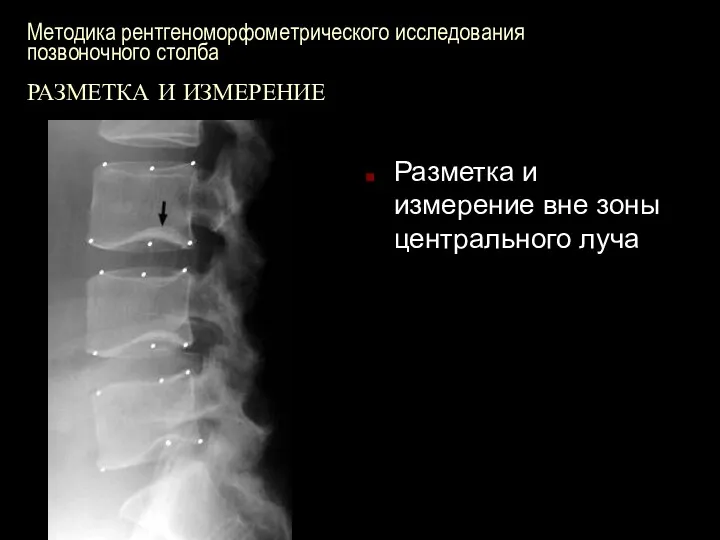 Методика рентгеноморфометрического исследования позвоночного столба РАЗМЕТКА И ИЗМЕРЕНИЕ Разметка и измерение вне зоны центрального луча