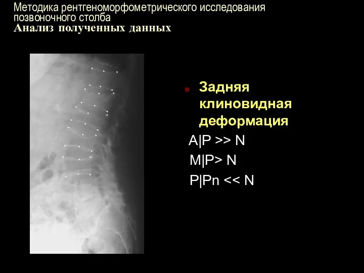 Методика рентгеноморфометрического исследования позвоночного столба Анализ полученных данных Задняя клиновидная